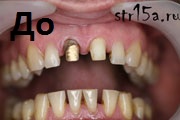 Протезирование зубов Случай №1 фото До