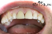 Протезирование зубов Соучай №1 фото 4