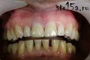 Протезирование зубов Случай №1 фото 5