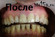 Протезирование зубов Случай №1 фото После