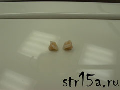 Протезирование зубов Случай №2 фото 1
