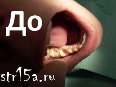 Протезирование зубов Случай №2 фото До
