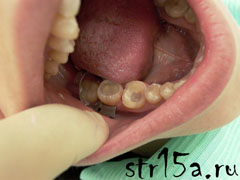 Протезирование зубов Случай №2 фото 3