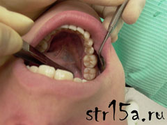 Протезирование зубов Случай №2 фото 4