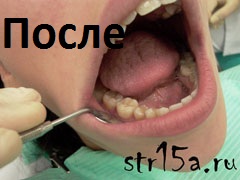 Протезирование зубов Случай №2 фото После