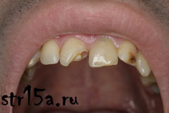 Реставрация зубов Случай №1  фото 1
