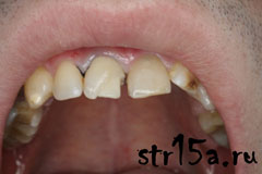Реставрация зубов Случай №1 фото 2