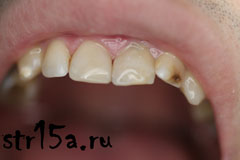 Реставрация зубов Случай №1 фото 3