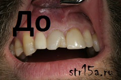 Реставрация зубов Случай №2 фото  До